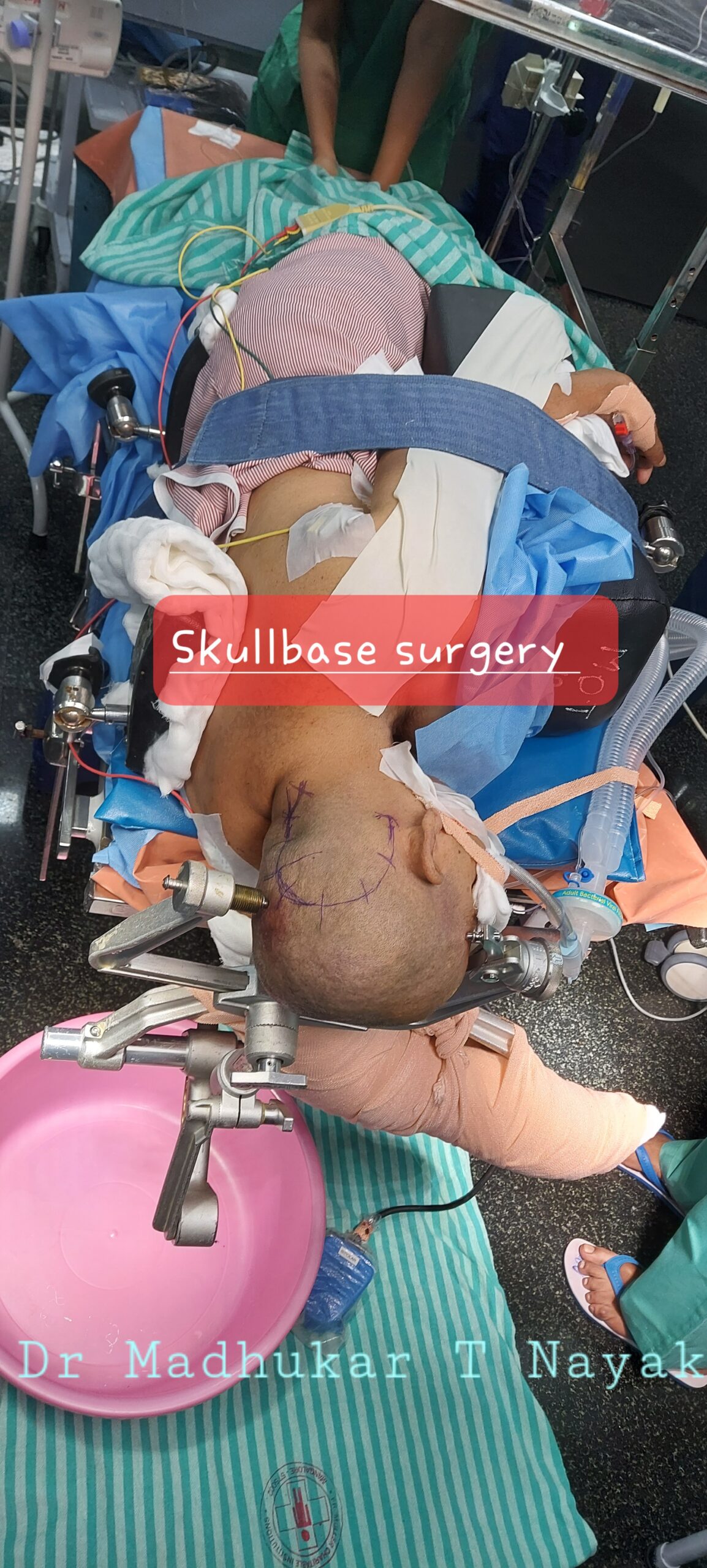 SKULL BASE SURGERY FOR POSTERIOR CRANIAL FOSSA : FAR LATERAL APPROACH INCISION
