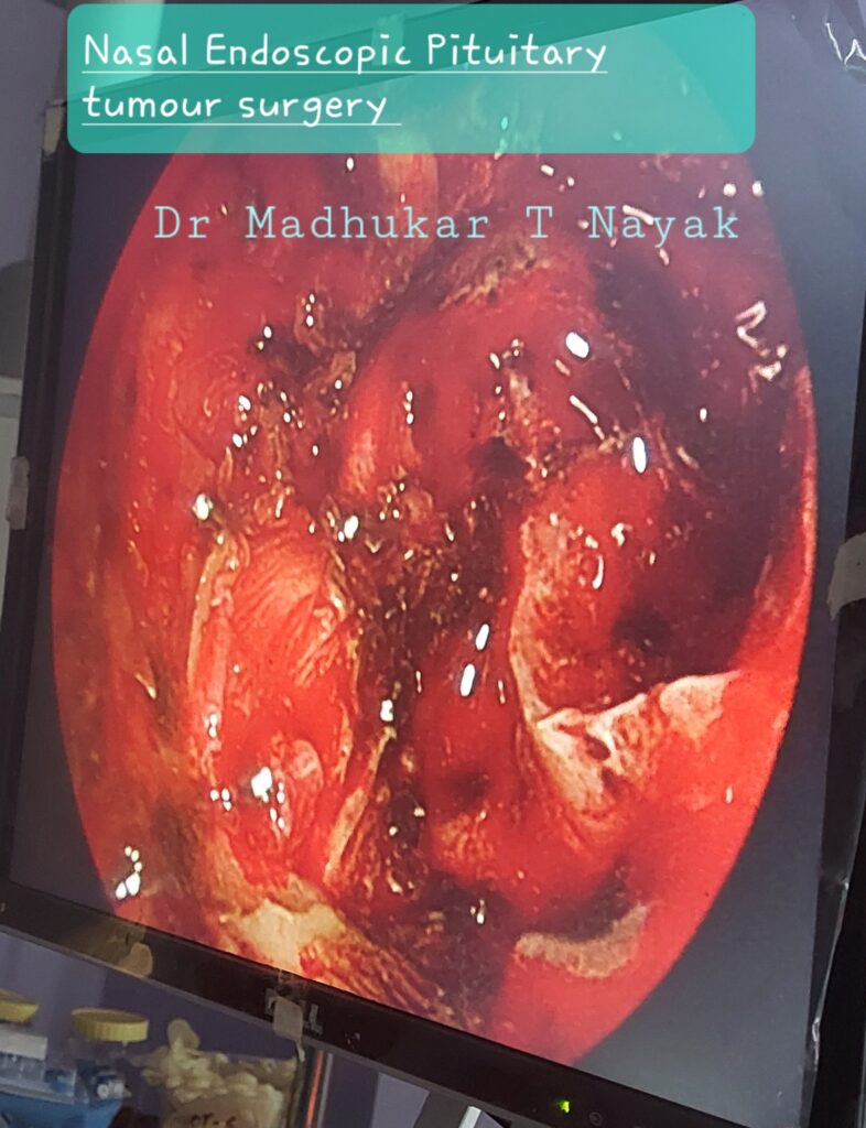 TRANS NASAL ENDOSCOPIC PITUITARY SURGERY