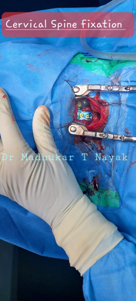 CERVICAL SPINE FIXATION PLATING