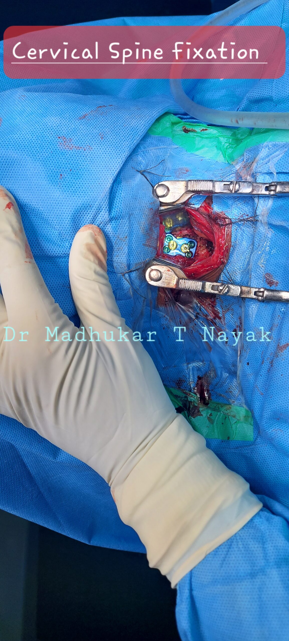 CERVICAL SPINE FIXATION PLATING