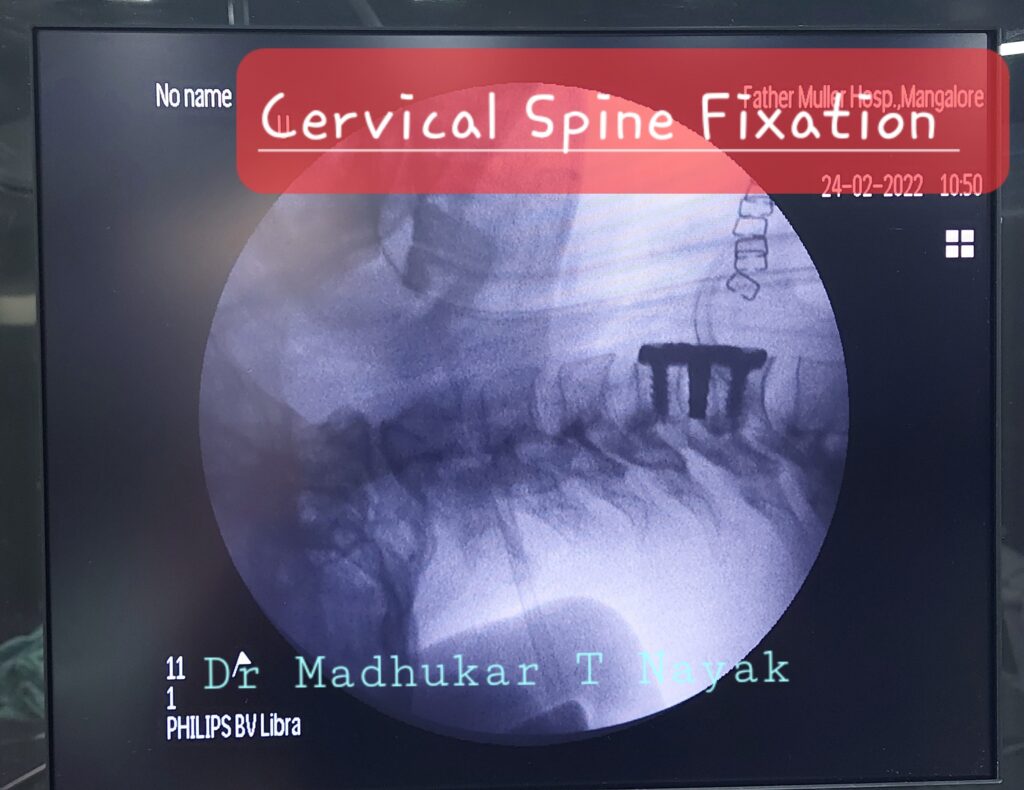 CERVICAL SPINE FIXATION : ANTERIOR CERVICAL DISCECTOMY AND FIXATION