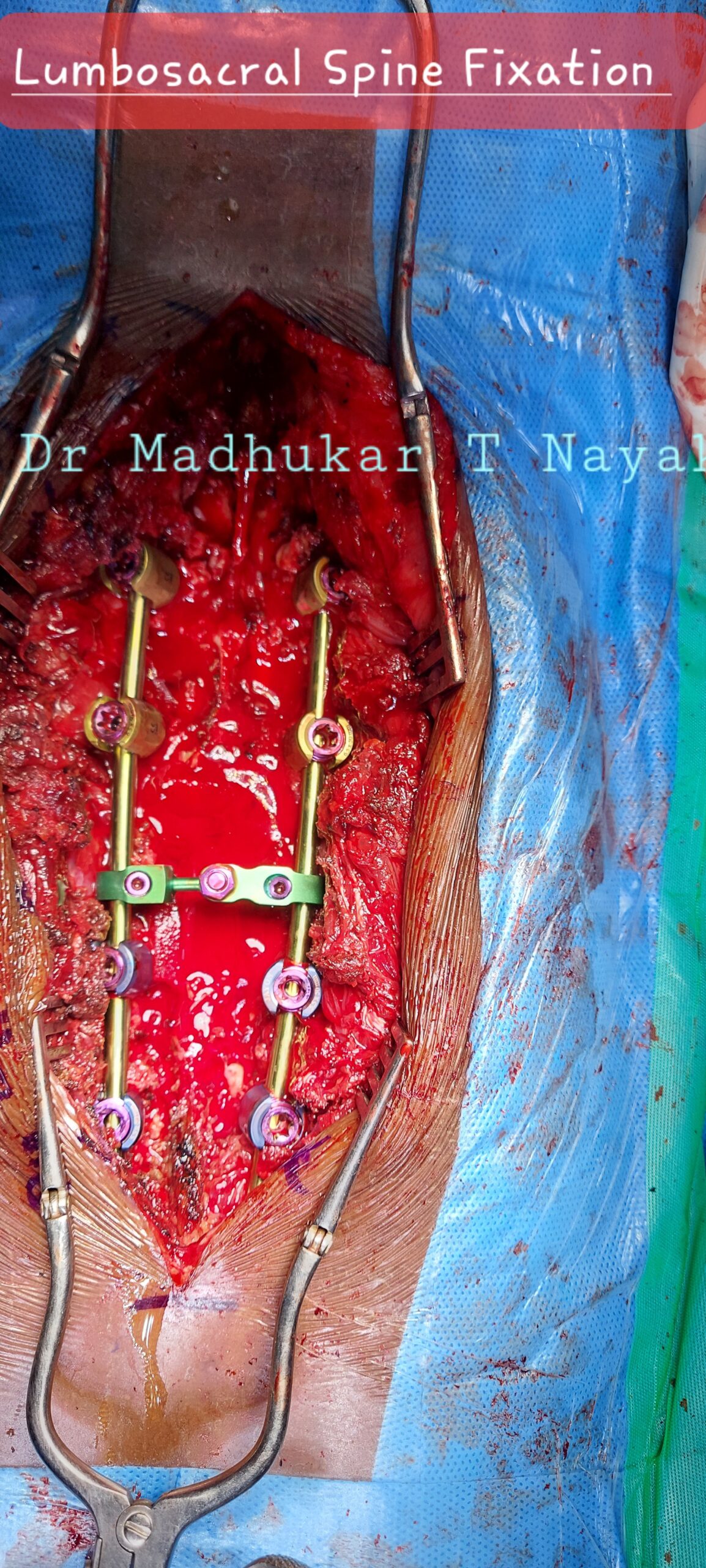 LUMBOSACRAL SPINAL STABILIZATION