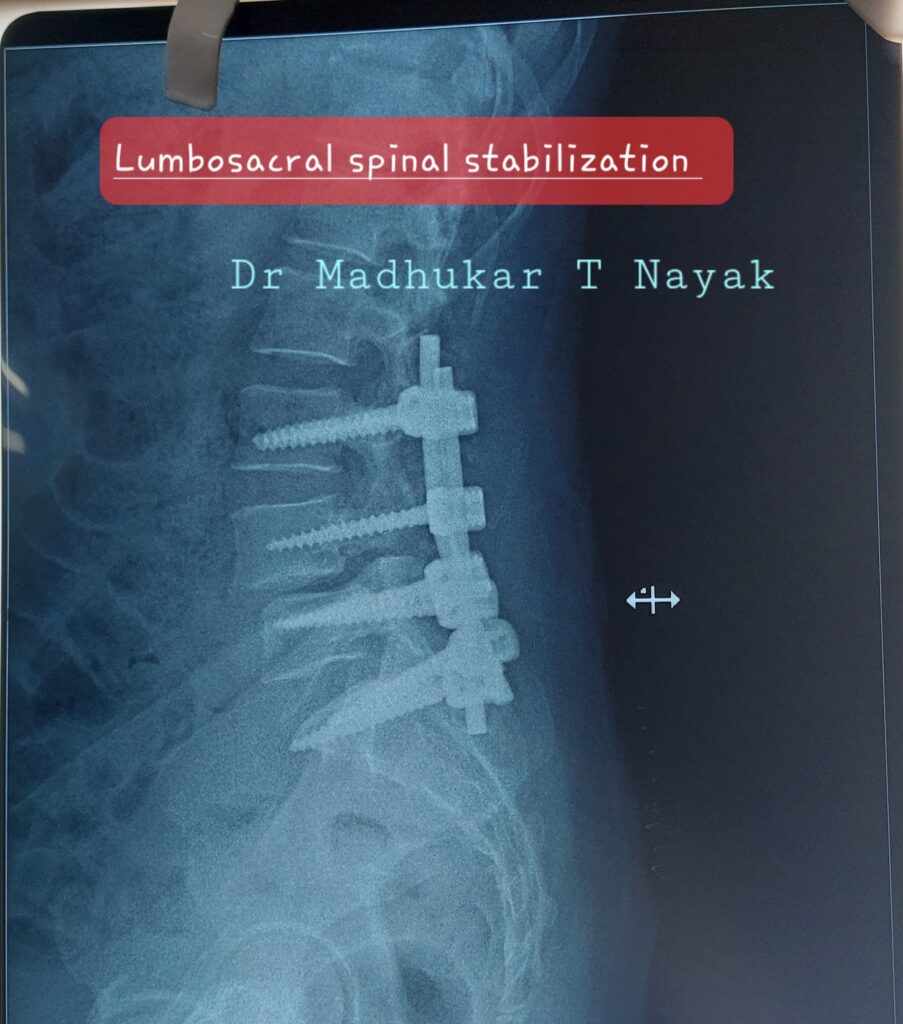 LUMBOSACRAL SPINE STABILIZATION