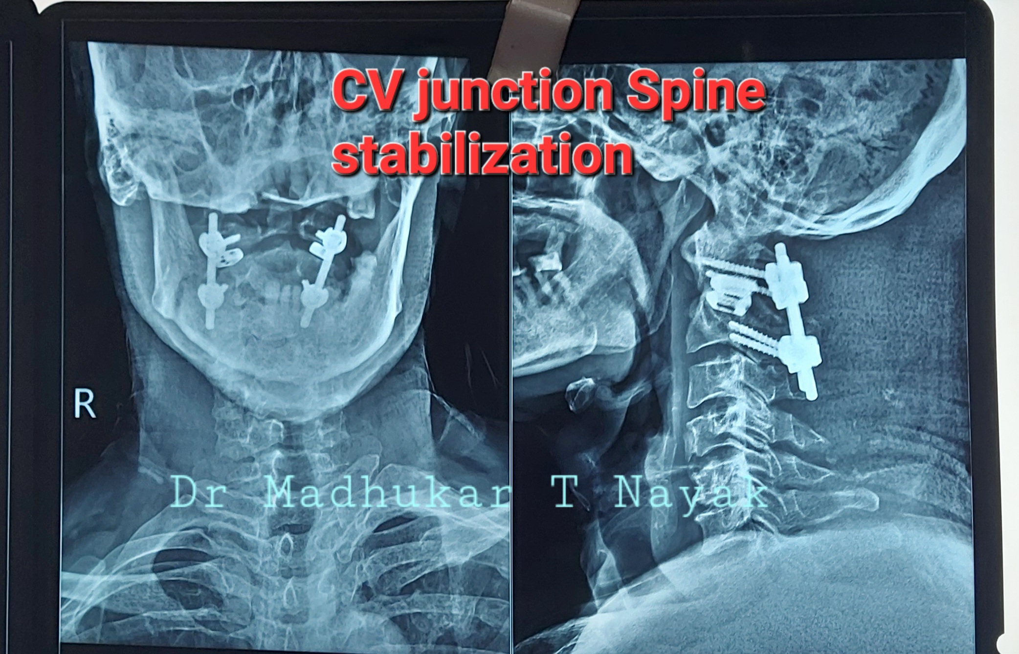 CV JUNCTION SPINE STABILIZATION SURGERY