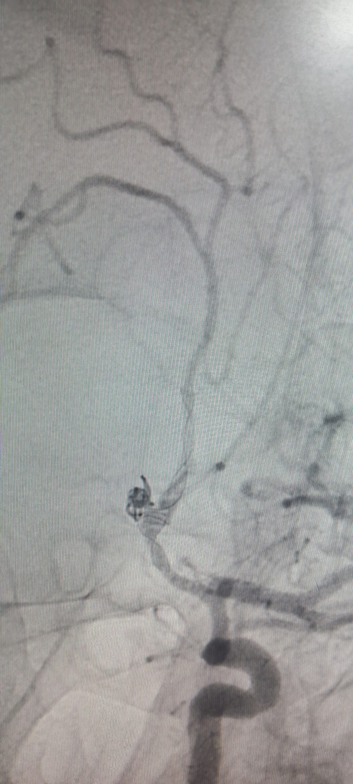 STENT ASSISTED COILING OF ACOM ARTERY ANEURYSM