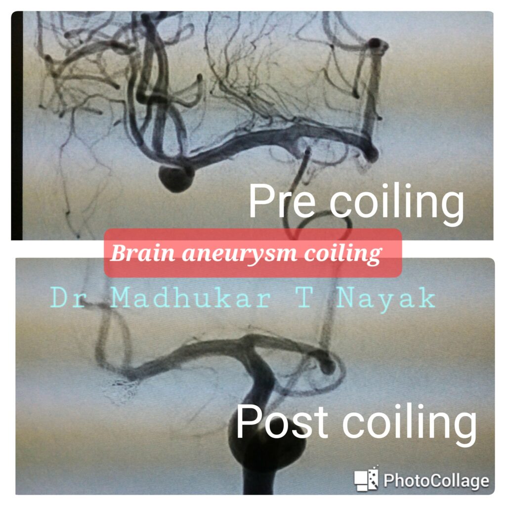 BRAIN ANEURYSM [ MCA] COILING