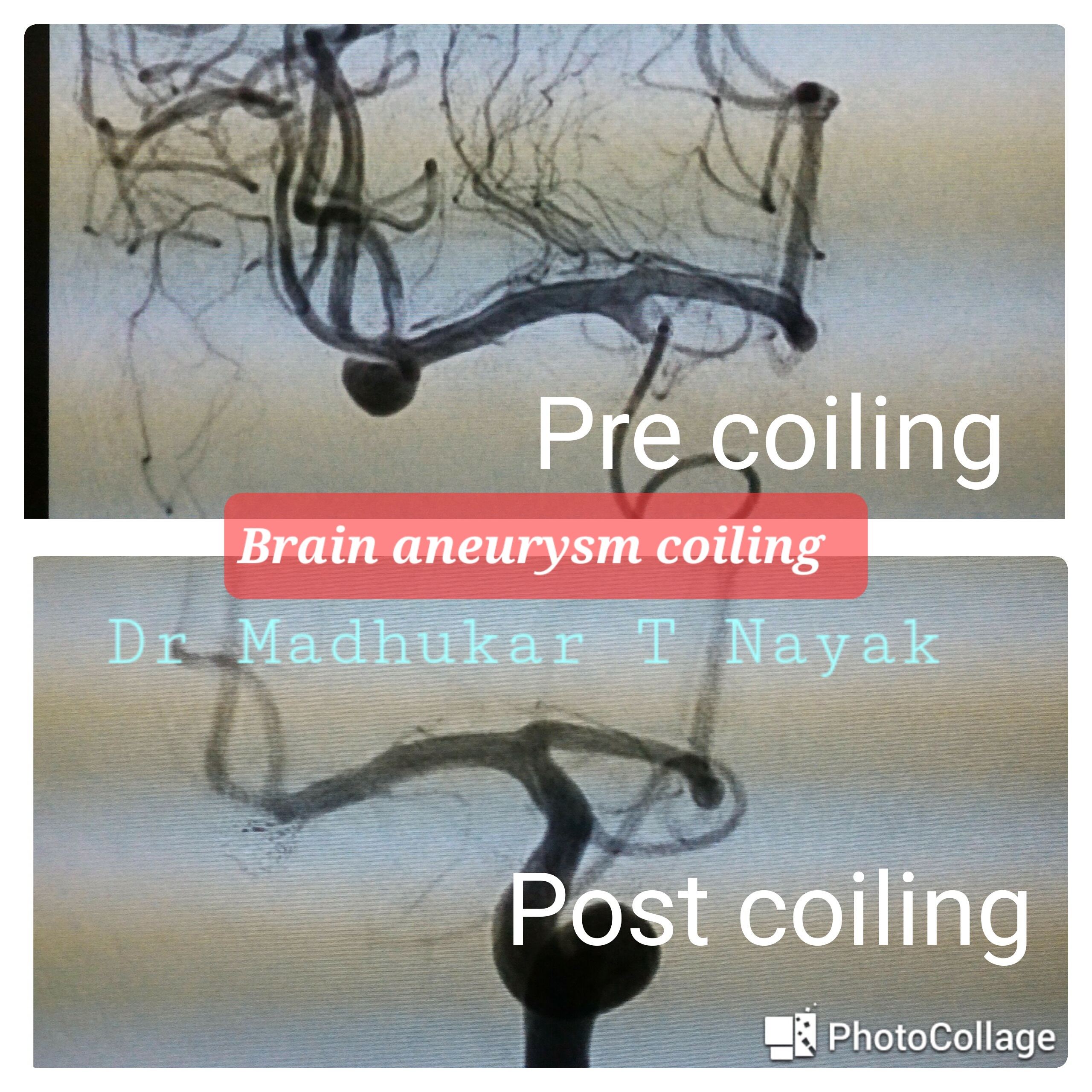 BRAIN ANEURYSM [ MCA] COILING