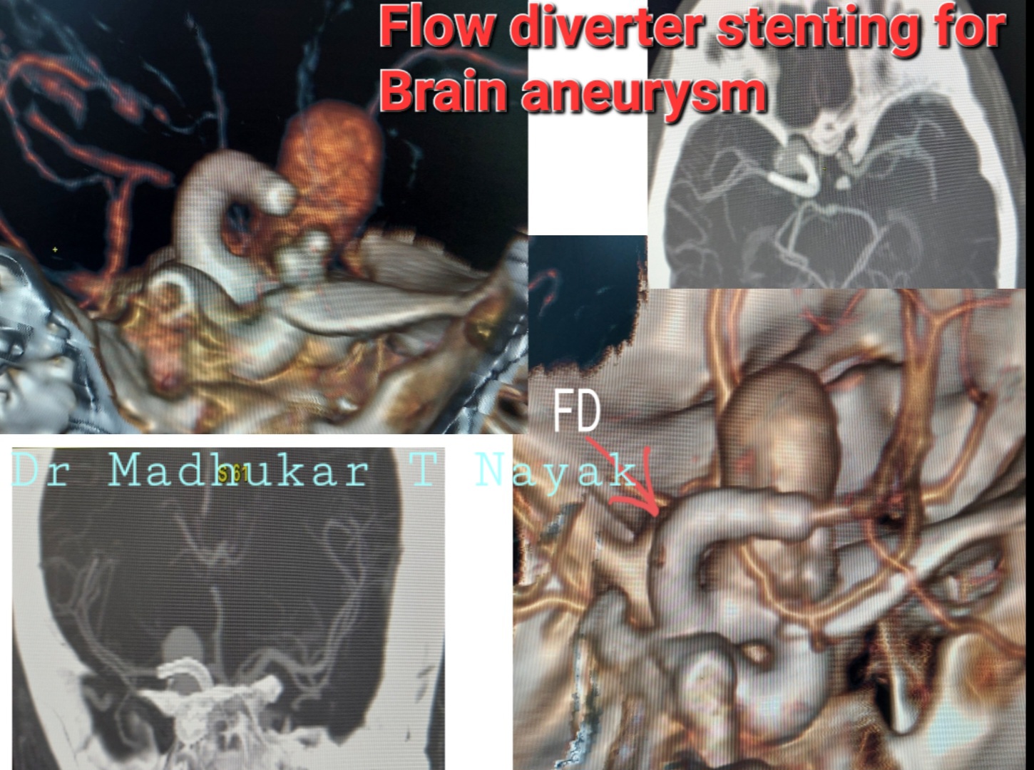 FLOW DIVERTER STENT FOR BRAIN ANEURYSM
