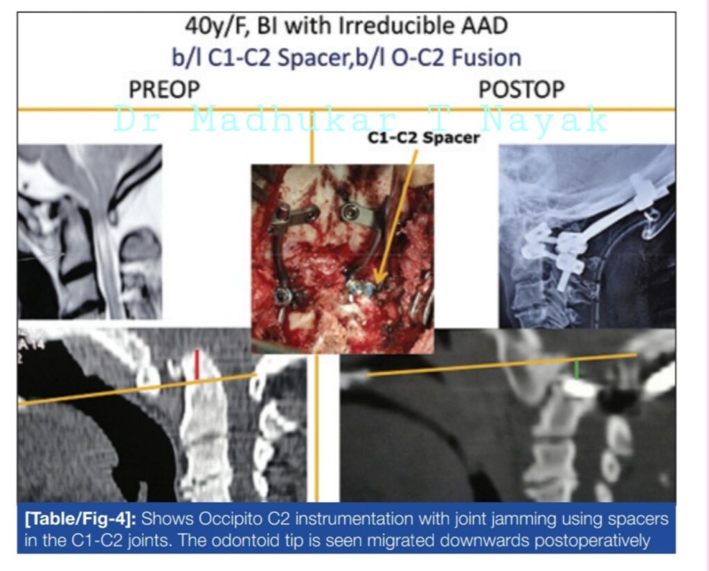 CV JUNCTION SPINE SURGERY : BASILAR INVAGINATION WITH ATLANTO AXIAL DISLOCATION