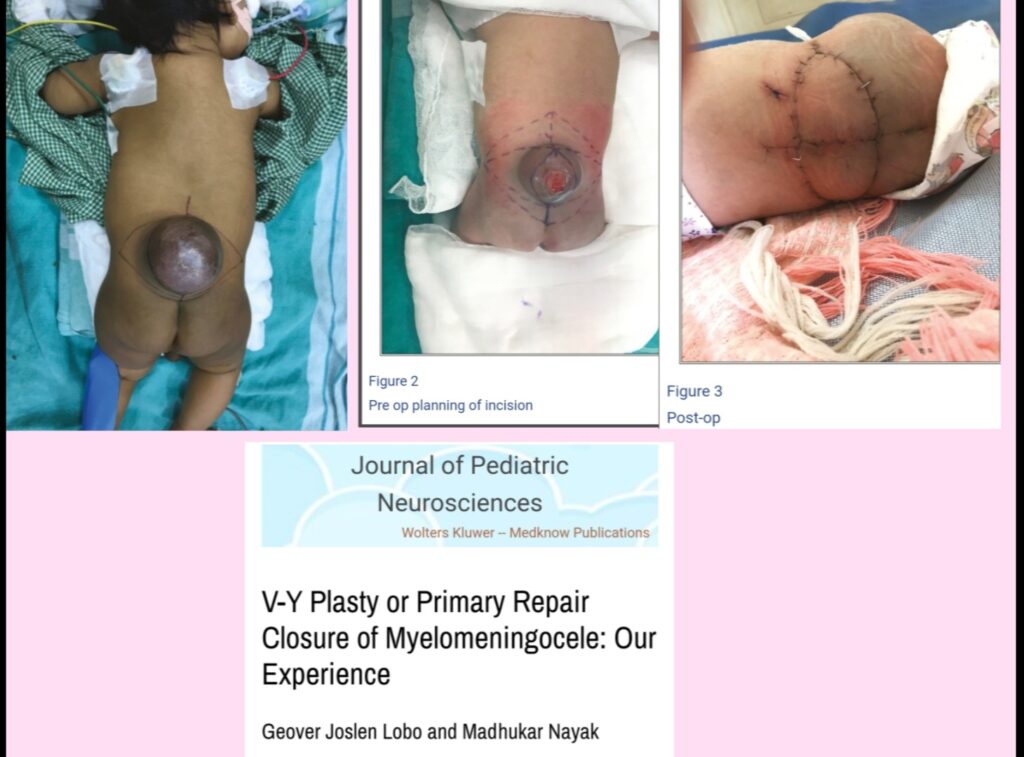 LUMBOSACRAL MENINGOMYELOCELE REPAIR : PAEDIATRIC NEUROSURGERY