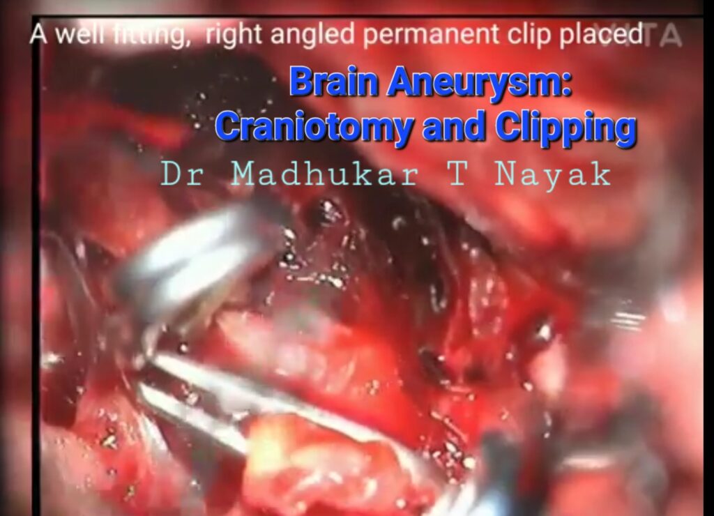 BRAIN ANEURYSM CRANIOTOMY AND CLIPPING