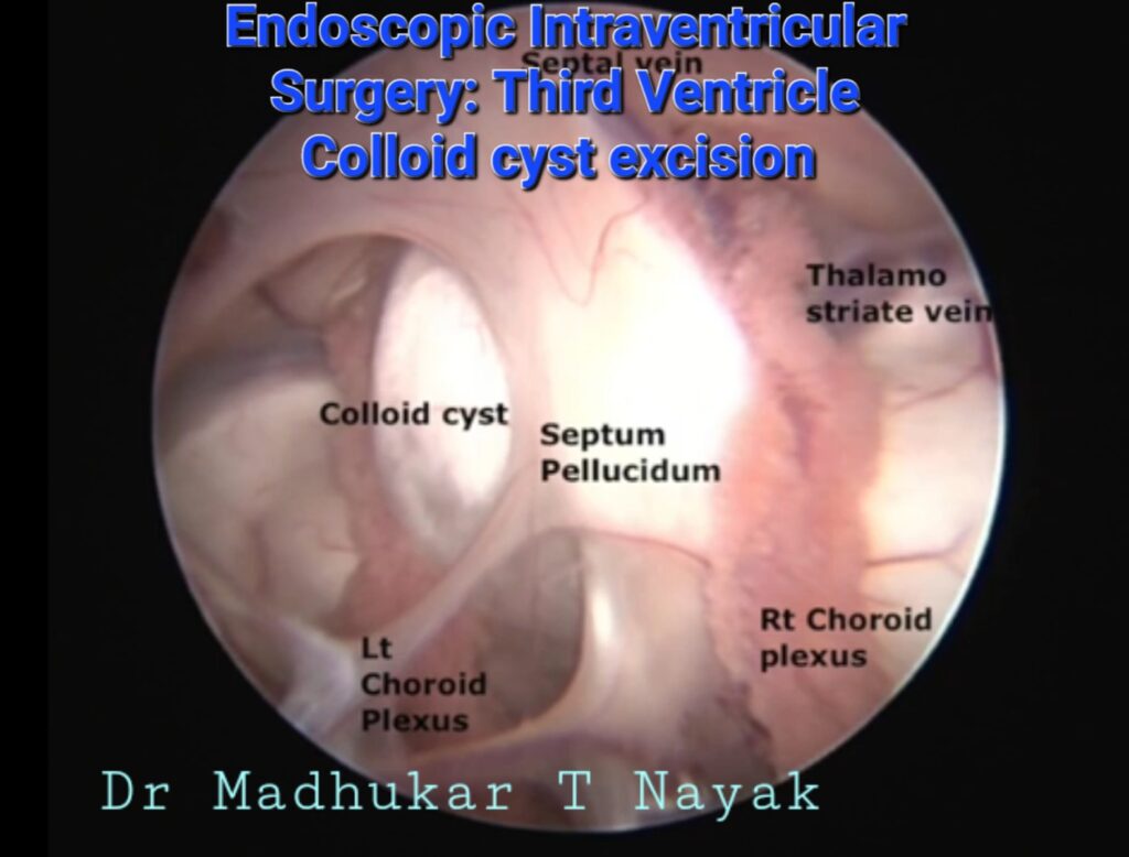 ENDOSCOPIC BRAIN COLLOID CYST EXCISION