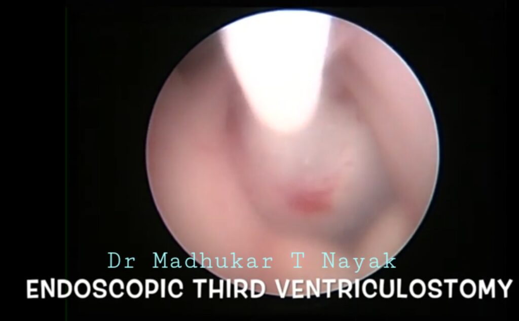ENDOSCOPIC THIRD VENTRICULOSTOMY