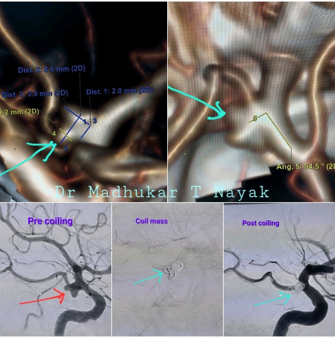 BRAIN ANEURYSM [ PCOM ICA] COILING