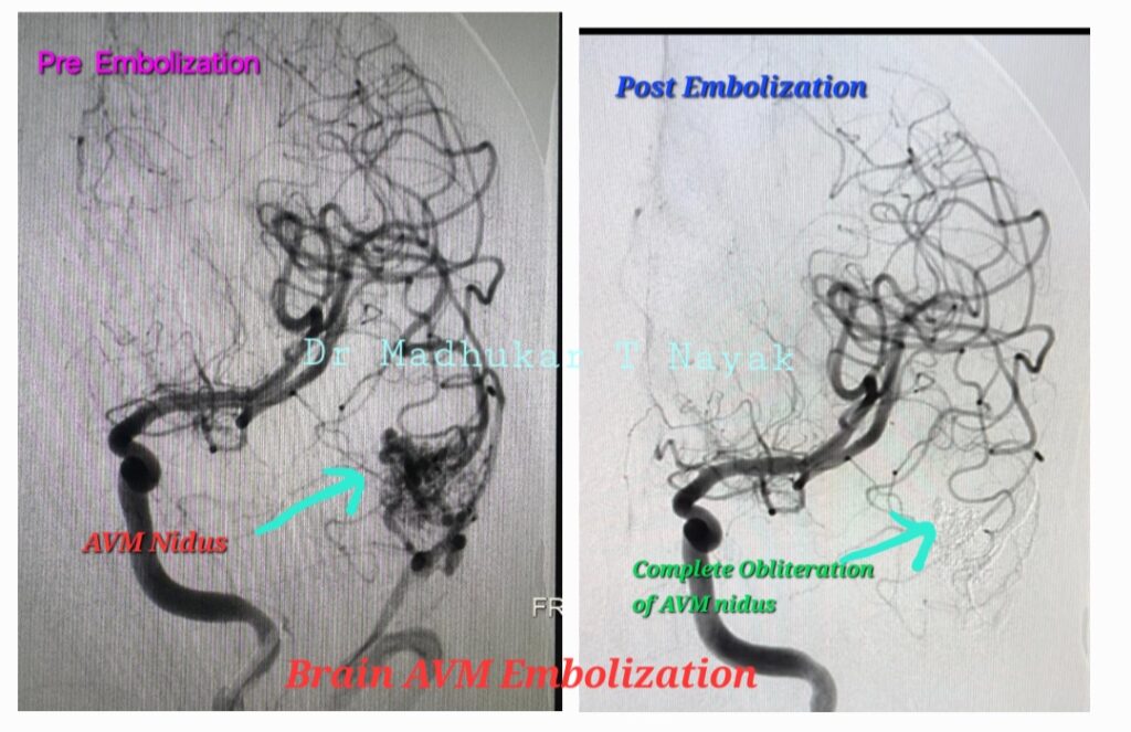 BRAIN AVM EMBOLIZATION