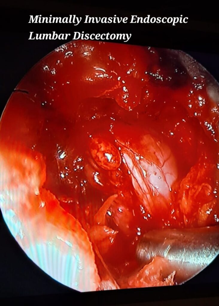 ENDOSCOPIC MIS LUMBAR DISCECTOMY