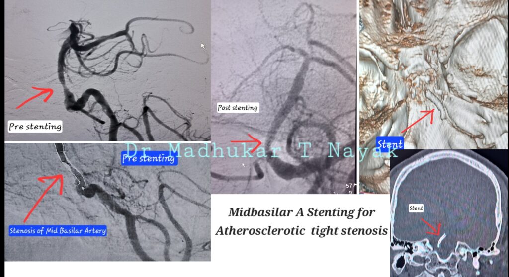 BASILAR ARTERY INTRACRANIAL STENTING FOR ATHEROSCLEROTIC STENOSIS