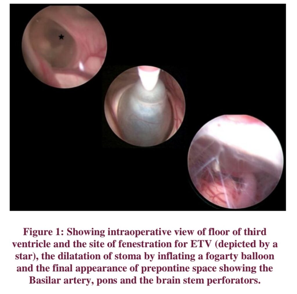 ENDOSCOPIC THIRD VENTRICULOSTOMY IN INFANT : PAEDIATRIC NEUROSURGERY