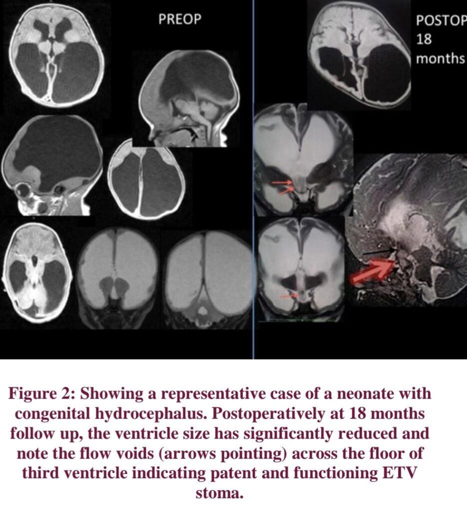 ENDOSCOPIC THIRD VENTRICULOSTOMY : PAEDIATRIC NEUROSURGERY