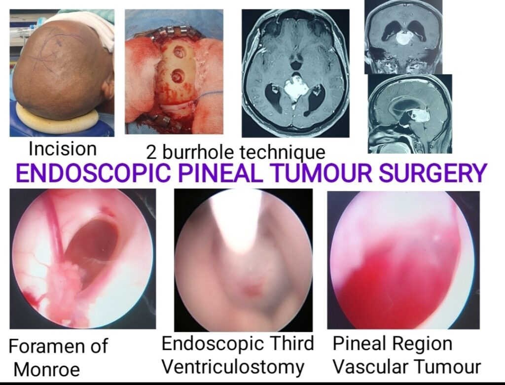ENDOSCOPIC BRAIN [ PINEAL TUMOUR] SURGERY]