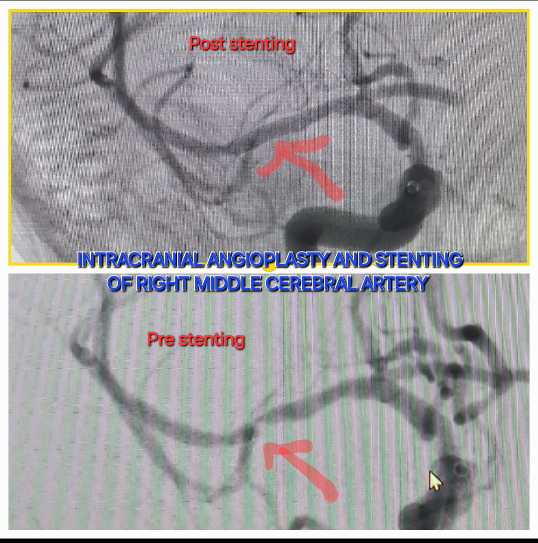 INTRACRANIAL MCA STENTING FOR ATHEROSCLEROTIC STENOSIS