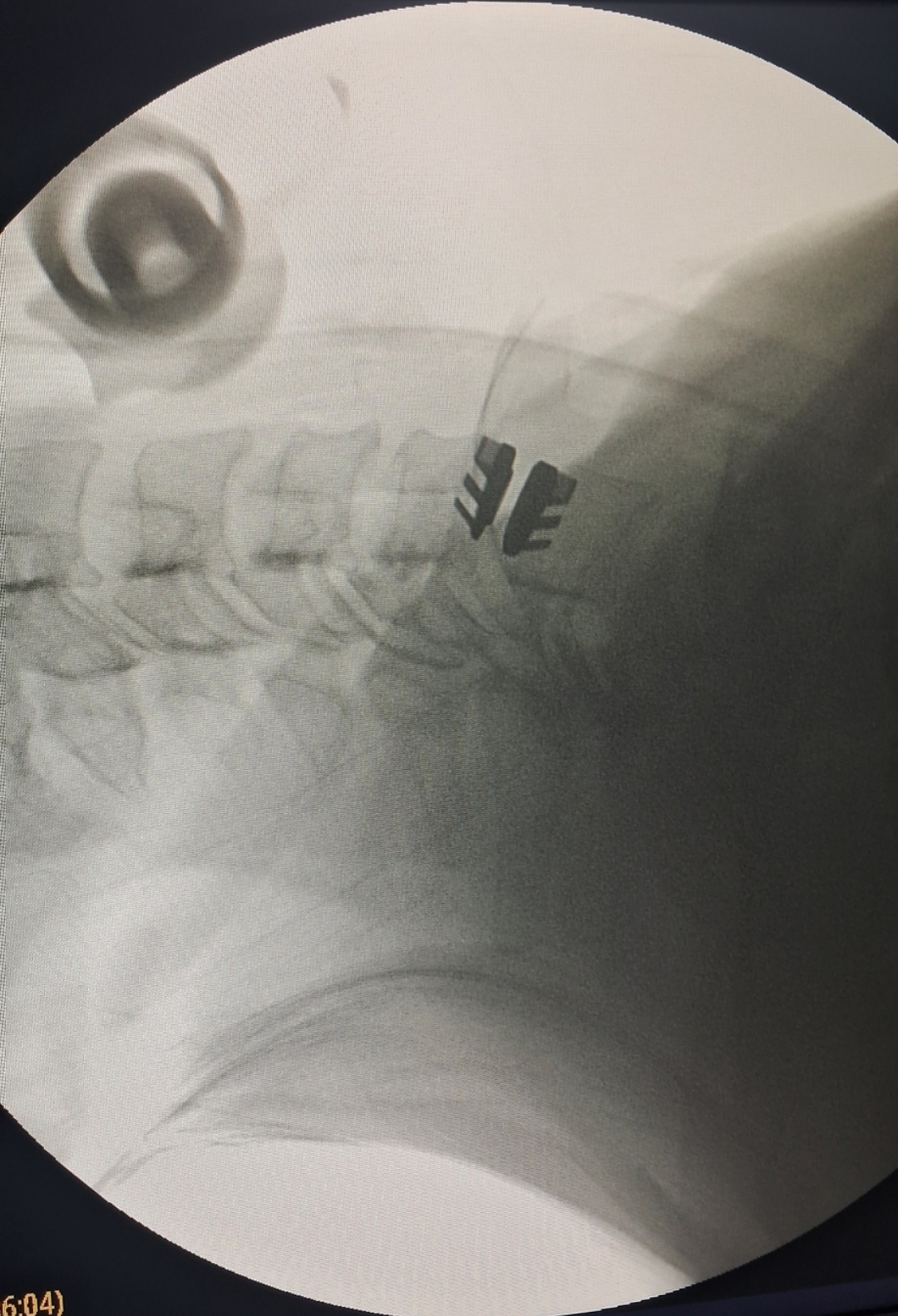CERVICAL DISC ARTHROPLASTY [ ARTIFICIAL DISC REPLACEMENT]